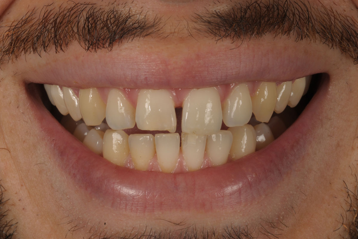 faccette-caso-1-dopo