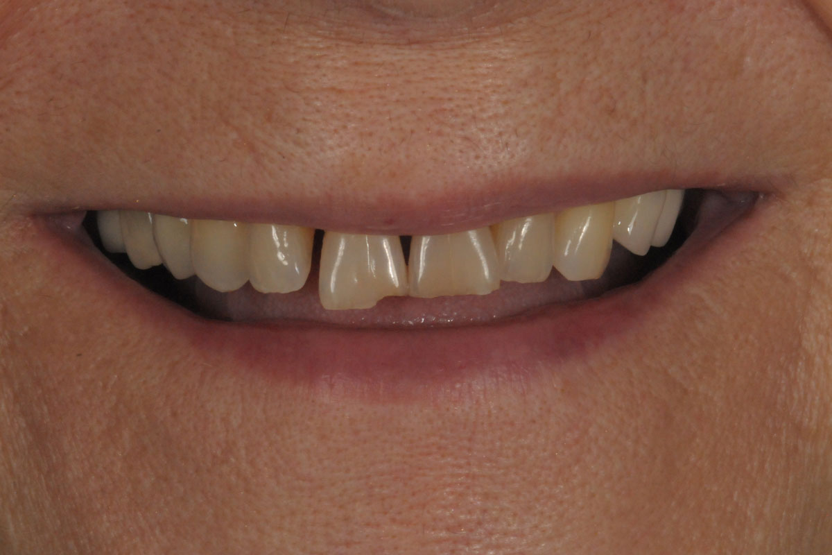 faccette-caso-2-dopo