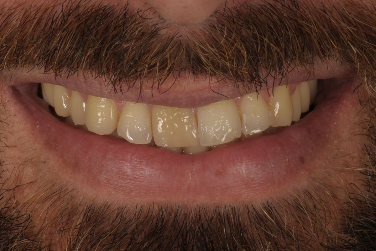 faccette-caso-3-dopo